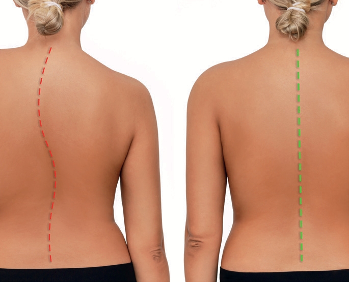 Sous quelle vue se déforment les vertèbres dans le cas d’une scoliose ?